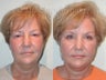 Facelift, Upper & Lower Blepharoplasty