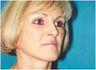Brow and Face Lift Upper Blepharoplasty with Lip Augmentation