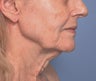 Facelift