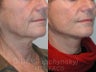 Sluplift- Mini Neck & Jowl Lift
