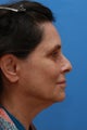 Face & Neck Lift, Browlift, Facial Fat Grafting