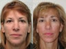 Facelift, Upper & Lower Blepharoplasty