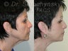 Sluplift- Mini Neck & Jowl Lift