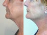 Sluplift- Mini Neck & Jowl Lift