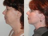 Facelift