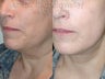 Sluplift- Mini Neck & Jowl Lift & Submental Liposuction