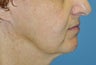 Facelift