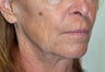 Facelift