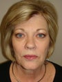 Facelift with quad blephorplasty