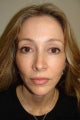 Facelift with browlift and lower blephorplasty