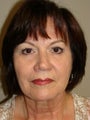 Facelift with browlift and lower blephorplasty