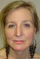 Facelift with browlift and lower blephorplasty