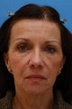 58 Year Old Lady After Revision Facelift