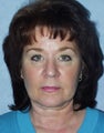 Facelift with Necklift