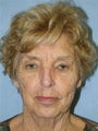 Facelift with Necklift