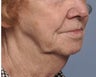 Facelift