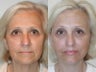 SLUPLift, Endoscopic Forehead Lift and Lower Blepharoplasty