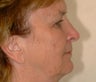 Face Lift, Blepharoplasty, and Brow Lift