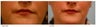 Lip Reduction/Lip Correction