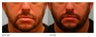 Lip Reduction/Lip Correction