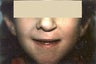 Cleft Lip and Palate Surgery