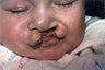 Cleft Lip and Palate Surgery