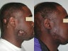Keloids