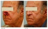 Facial Reconstruction