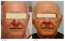 Facial Reconstruction