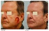 Facial Reconstruction