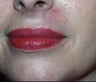 Mohs defect upper lip