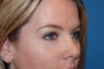 Skin Cancer Removal