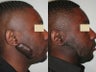 Keloids