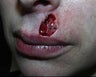 Mohs defect upper lip