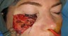 Skin Cancer Removal