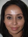 Rhinoplasty and Lower Lid Blepharoplasty