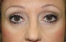Facial Combination Procedure