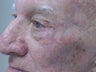 Facial Reconstructive Surgery- Cancer