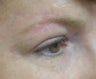 Facial Reconstructive Post Cancer