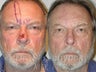 Forehead Flap Closure