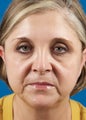 Facelift, Necklift, CO2 Laser