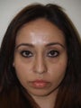 Rhinoplasty and Lower Lid Blepharoplasty