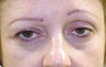 Facial Combination Procedure