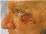 Facial Reconstructive Surgery- Cancer