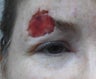 Facial Reconstructive Post Cancer