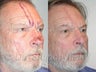 Forehead Flap Closure