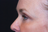 Eyelid Surgery / Fat Grafting