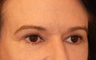 Eyelid Surgery / Fat Grafting