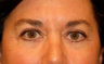 Eyelid Surgery / Fat Grafting