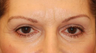 Eyelid Surgery / Fat Grafting